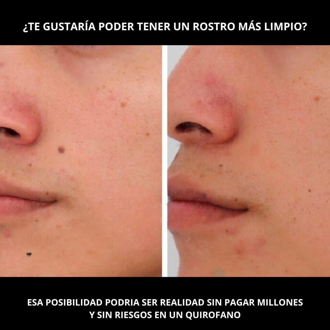 GlowAway™️ - La Solución para una Piel Perfecta al Instante
