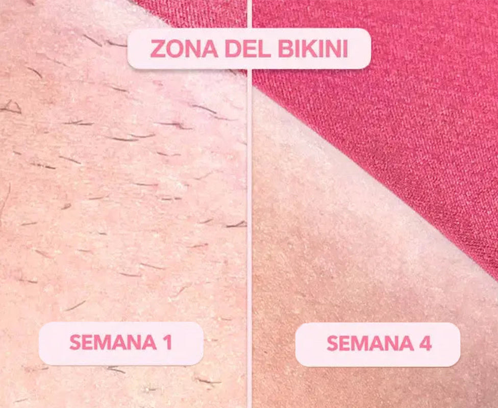 Depiladora Láser IPL Permanente